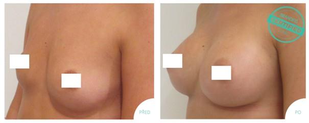 Zvětšení prsou - Před a Po